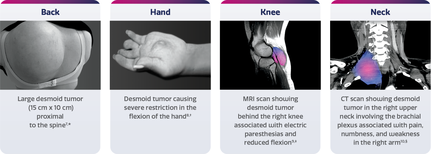 desmoid tumor example images